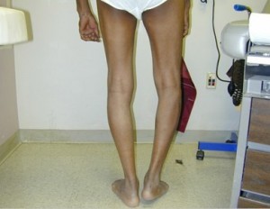 dismetria degli arti inferiori (gamba corta)